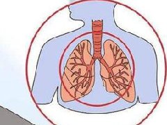 慢性支气管炎的症状临床表现_中医慢性支气管炎怎么办治疗