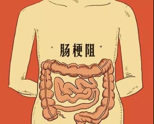 动力性肠梗阻图片