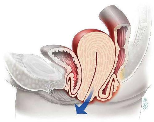 直肠脱垂是什么症状和表现用中医来解释