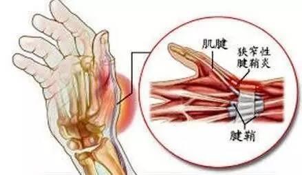 手2345指屈肌肌腱腱鞘炎是什么症状和表现用中医来解释